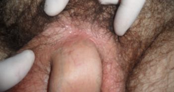 PENILE ENHANCEMENT PROCEDURES: UROLOGICAL AND ETHICOLEGAL ISSUES