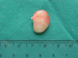 Nasal papilloma treatment Case Report Sinonasal inverted papilloma medial maxillectomy