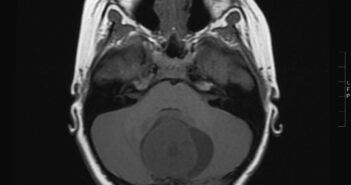 POSTERIOR FOSSA TUMORS: A CASE REPORT OF ACQUIRED TORTICOLLIS IN CHILDREN