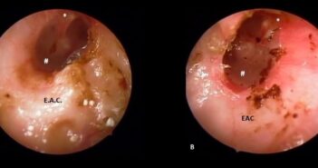 MANAGEMENT OF BILATERAL IDIOPATHIC CHOLESTEATOMA OF THE EXTERNAL AUDITORY CANAL: A CASE REPORT