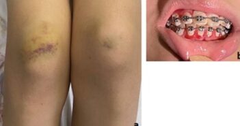 SKELETAL PAIN IN CHILDREN: DON’T FORGET SCURVY! A PAEDIATRIC CASE SERIES