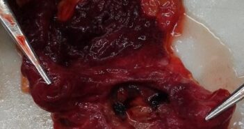 THE DEADLY DUODENAL ULCER, THE SUDDEN DEATH YOU DO NOT EXPECT: TWO CASES IN A ROW